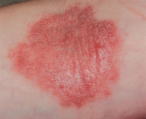 What Is Causing The Rash On This Womans Inner Elbow Consultant360
