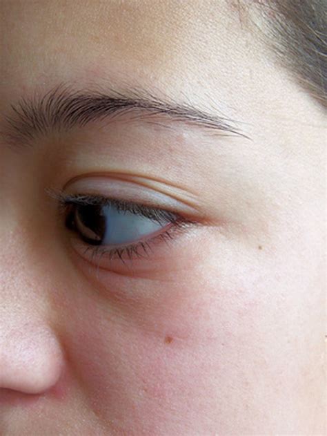 What Are The Causes Of A Sore Swollen Eyelid