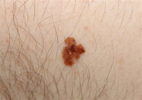 Melanoma Symptoms Stage Pictures Symptoms And Pictures