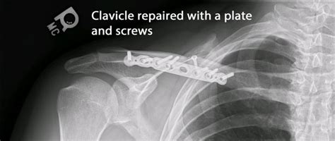 Clavicle Fractures Dr Michael Codsi Patient Education
