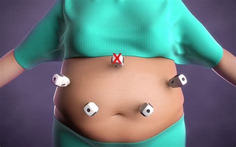 Weight Loss Surgery Using Less Invasive Magnetic Surgery Techniques