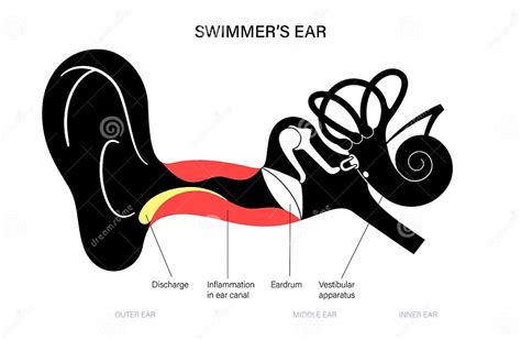 Swimmers Ear Otitis Stock Vector Illustration Of Swimmer 231031861