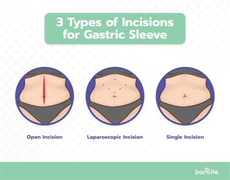Gastric Sleeve Incisions Everything You Need To Know