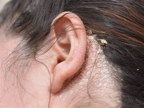 Are Fungal Infections On The Scalp Dangerous Balmonds