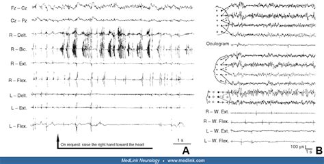 Myoclonic Seizures Medlink Neurology