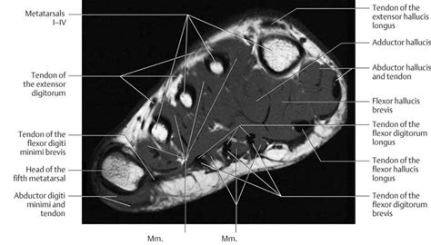 Foot Muscles Mri Plantar Fibroma And Fibromatosis Mr Malik At Lfac