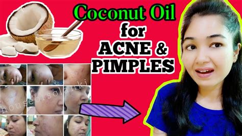 क्या Coconut Oil से Acnepimples ठीक किये जा सकते है How To Use