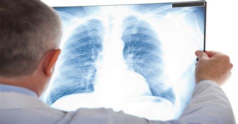 In a 2015 study, peritoneal mesothelioma patients who could not undergo surgery had median survival times of 11 months if they received palliative. Research Shows Combination Therapy Improves Survival