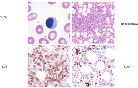 What Is Large Granular Lymphocytic Leukemia Lgll