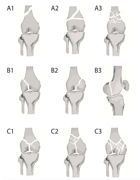 We help you diagnose your distal femur case and provide detailed descriptions of how to manage this and hundreds of other pathologies. Periarticular Fractures of the Knee in Polytrauma Patients