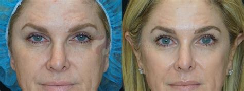 Chemical Peels Before And After Photo Gallery Dallas Plano And
