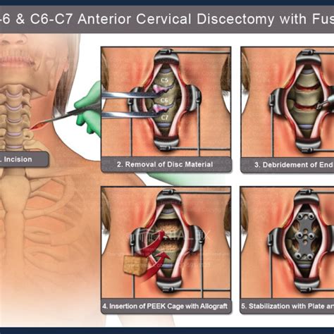 C C Anterior Cervical Discectomy And Fusion Trialexhibits Inc