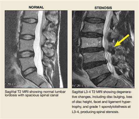 Annotated Color Mri Lumbar Spine Spinal Stenosis Spinal Stenosis
