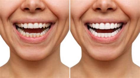Composite Vs Porcelain Veneers Which Is Better For You Your Smile