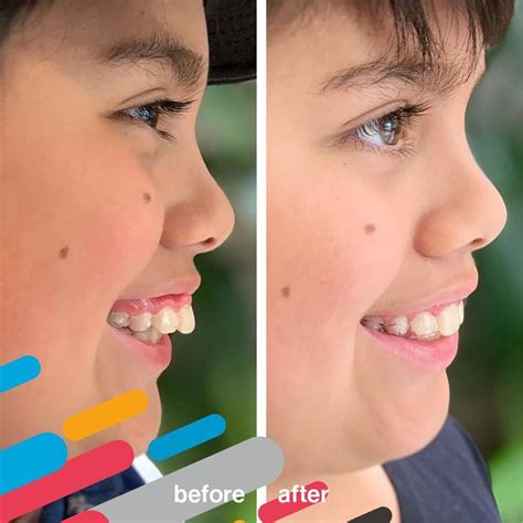 Invisalign Before And After Photosdr Jacquie Monroe Ortho