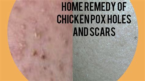 Skin Care Chicken Pox Ayurvedic Natural Home Remedies How To