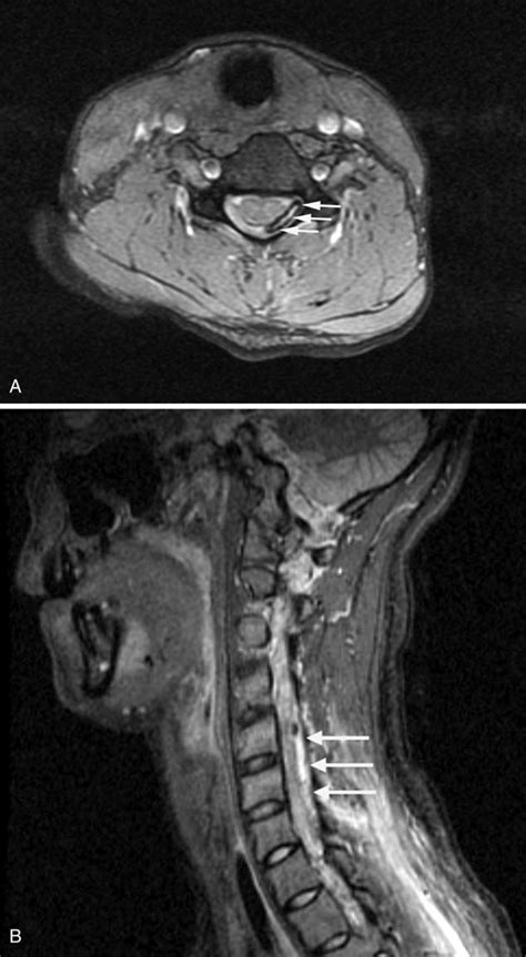 Cervical Spine Mri With Iv Contrast A Axial 2d Multiple Echo