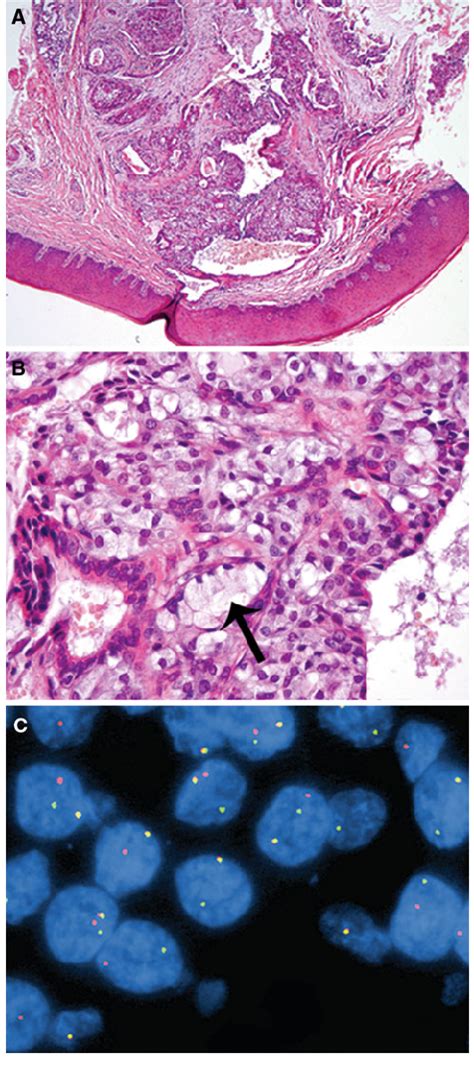 A Mucoepidermoid Carcinoma The Cystic Lesion Involves The Hard Palate
