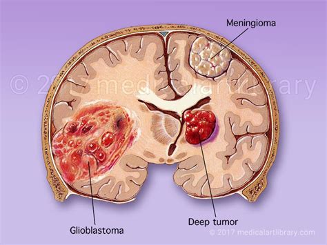 Brain Tumor Glioblastoma Meningioma Medical Art Library