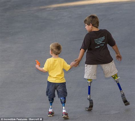 Kids With No Arms And Legs Prove That There Are No Limits