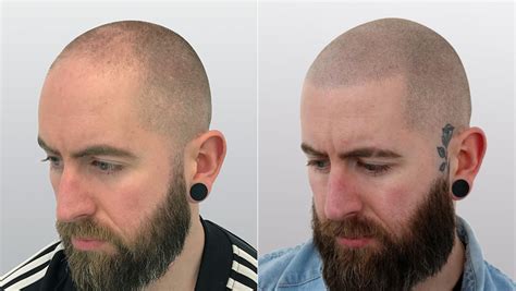Check spelling or type a new query. SMP (Scalp Micro Pigmentation) - HQ Hair Transplants