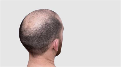 What Causes Hair Loss For Men And Women
