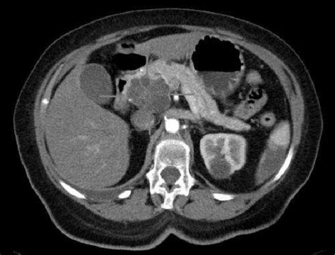 Pancreatic cancer (cancer of the pancreas) mainly occurs in people aged over 60. High insulin production may contribute to pancreatic cancer