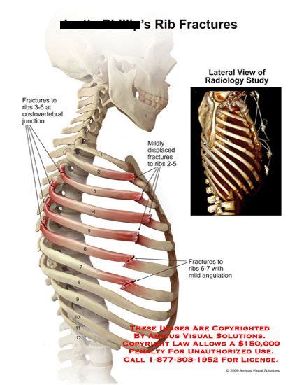 Sep 22, 2020 · the chest wall is composed of layers of muscle, bony ribs, costal cartilages, sternum, clavicles, and scapulae. amicus,injury,rib,fractures,costovertebral,junction,displaced,angulation,radiology,osirix | Rib ...