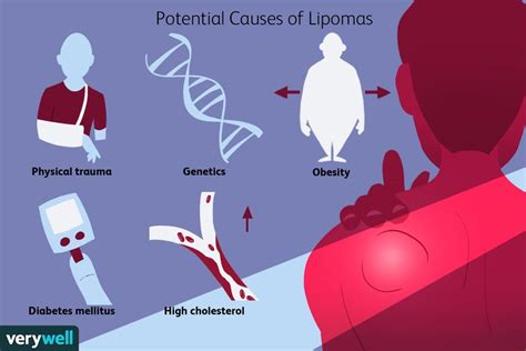 Lipoma Symptoms Causes Diagnosis And Treatment