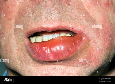 Swollen Lip Of A 79 Year Old Man Caused By Angioedema Angioneurotic