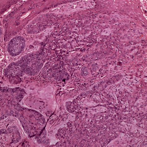 Basal Cell Carcinoma Nests Of Basaloid Cells Project From The