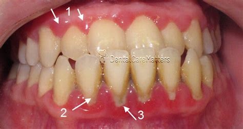 Petmd Green Stains On Teeth Near Gums
