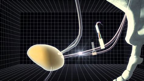 new device in uk to restore bladder control to the paralyzed youtube