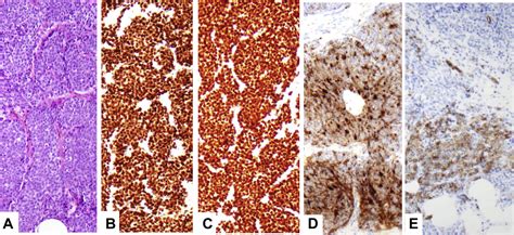 Neuroendocrine Carcinoma Of The Breast With Endobronchial Metastases