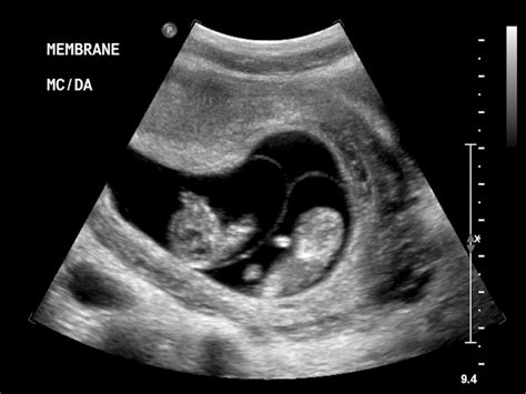 Monochorionic Diamniotic Twins Ultrasound
