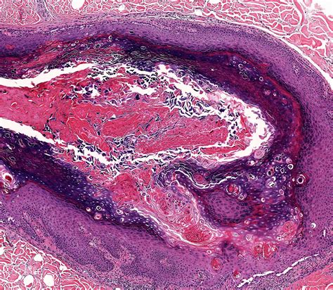 Pathology Outlines Warty Dyskeratoma
