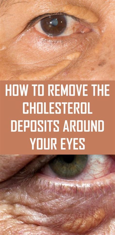 How To Remove The Cholesterol Deposits Around Your Eyes Health Care Later