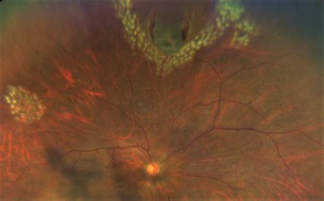 Retinal Tear Brisbane Ophthalmologist Retina Treatment