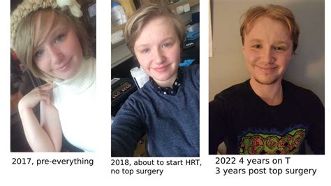 Mtf Around 2 Years Hrt And Recent Breast Augmentation Very Happy With