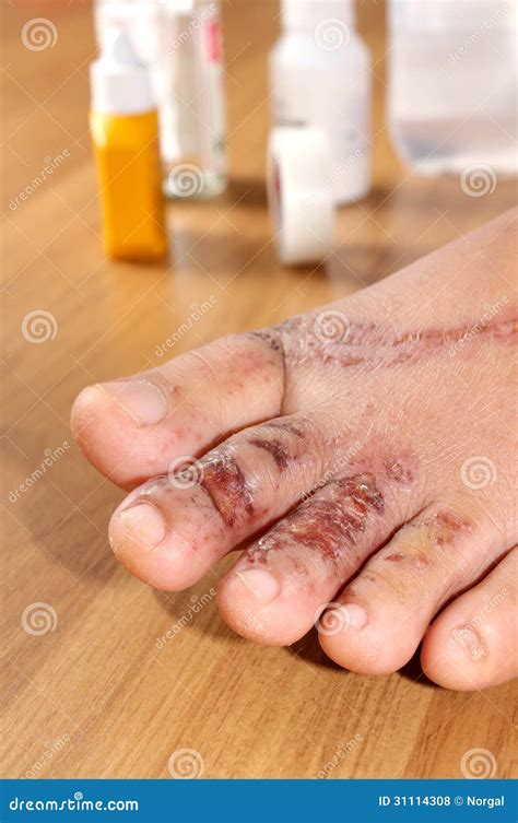 Wounds On Women Foot Royalty Free Stock Image 31114324