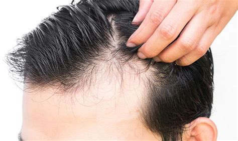 Mens Hair Loss What Are Your Options Dr Fox