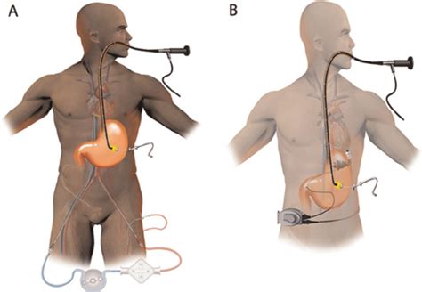 Illustration Shows Typical Percutaneous Gastrostomy Peg Procedure On