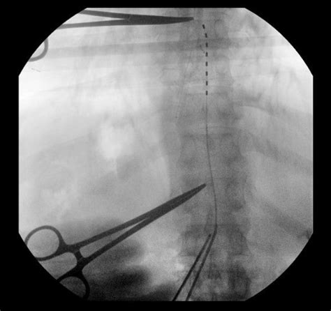 Cureus Percutaneous Thoracic Spinal Cord Stimulator Placement