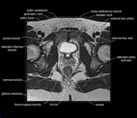 Pelvis Muscles Mri Anatomy Multimodality Imaging Of Pelvic Floor Images And Photos Finder