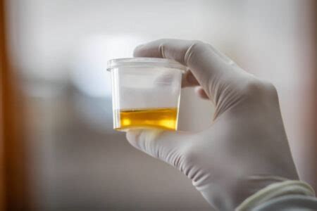 Alerta Cheiro Forte Na Urina Pode Ser Sintoma De Algo Mais Grave