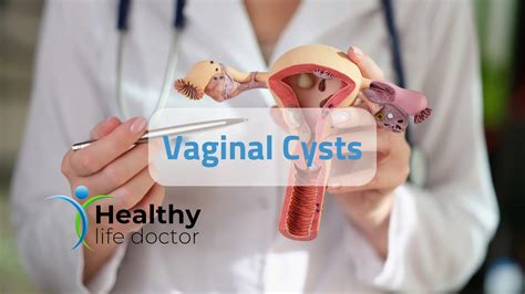 Vaginal Cysts The Best Way To Diagnose And Treat My Xxx Hot Girl