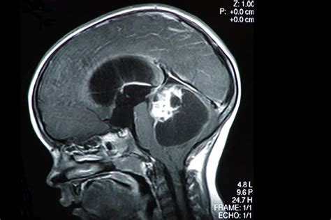 New Hope For Children With Brain Tumors Neuroscience News