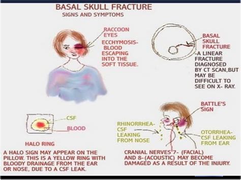 Meaning of basal skull fracture medical term. Tbi latest edition copy