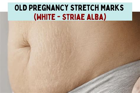 When Do Pregnancy Stretch Marks Appear And How To Treat Them