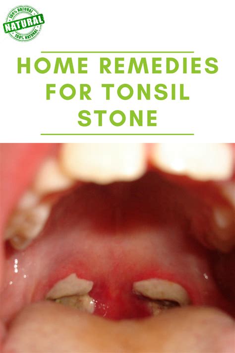 Remedies For Swollen Tonsils Throat Remedies Tonsil Stone Removal